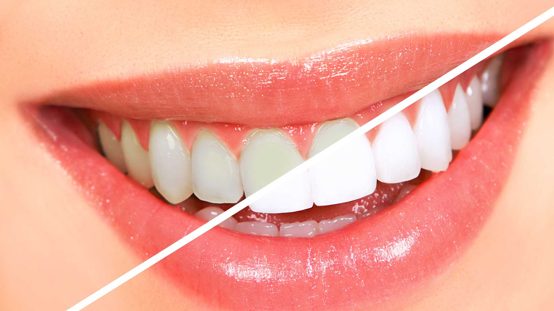 Best Teeth Whitening Services